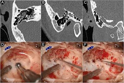 Influence of sigmoid plate and dura mater on vascular wall displacement, vibroacoustic/hydroacoustic sources characteristics, and frequency-loudness assessments of venous pulsatile tinnitus: A coupled-computational fluid dynamics study combining transcanal recording investigation